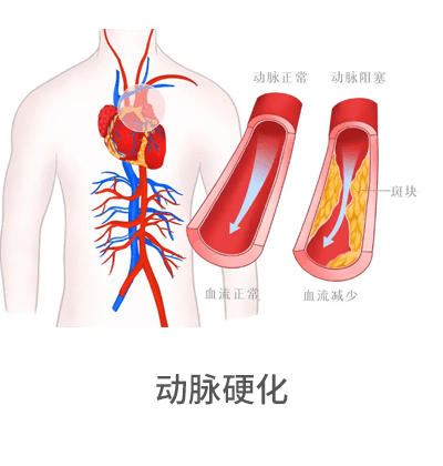 動(dòng)脈硬化檢測(cè)儀